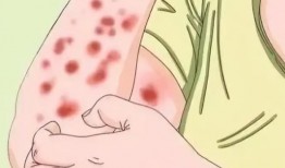 身上发痒可以吃瓜吗,吃瓜能缓解吗？揭秘身体发痒与饮食的关系